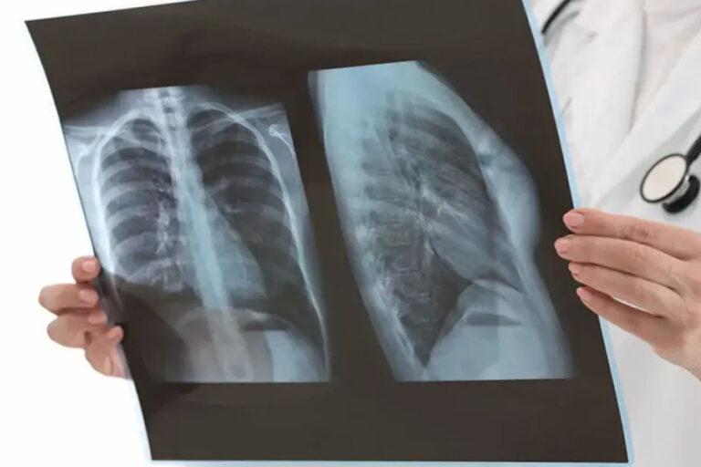 Imagen: Hidalgo: Cobró el cáncer la vida de 193 personas en el primer bimestre de 2026, ¿de qué tipo fue?